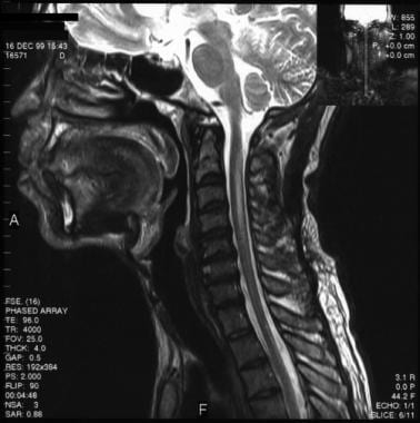 HIV Associated Vacuolar Myelopathy Overview Pathophysiology