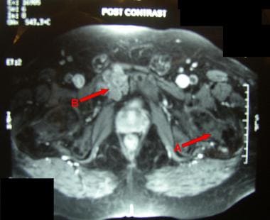 MRI of chondrosarcoma (B) shows contrast enhanceme