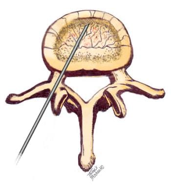 Transpedicular placement of a trocar in the anteri