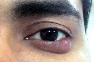 Photograph of a left lower lid chalazion. 