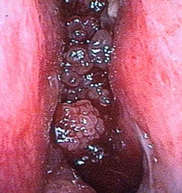 Nasal endoscopy showing a friable tumor of the lat