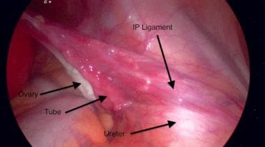 Ureter in relatie tot het infundibulopelvic li