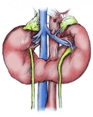 Horseshoe kidney. 