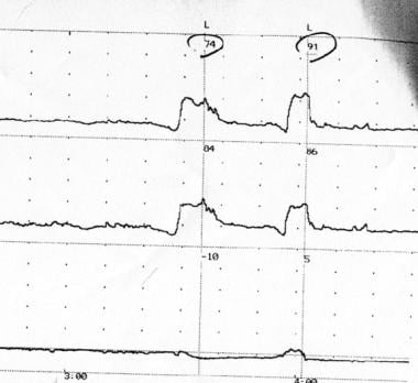 Urethral pressure profiles at rest and on stress in four groups of