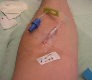 Labeling for IV cannulation. 