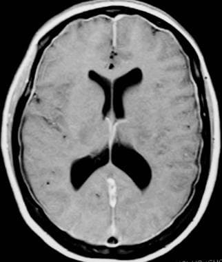 Gadolinium-enhanced T1-weighted axial MRI shows di