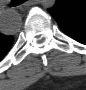 Axial CT myelogram shows posterior, central disk p