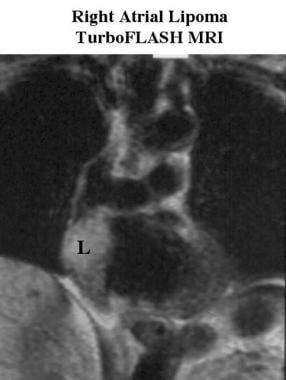 Coronal turbo fast low-angle shot (FLASH) MRI scan