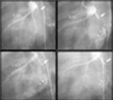 X-ray angiography is the criterion standard for de