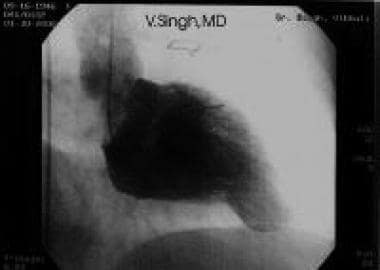 Left ventricular (LV) cineangiogram obtained durin