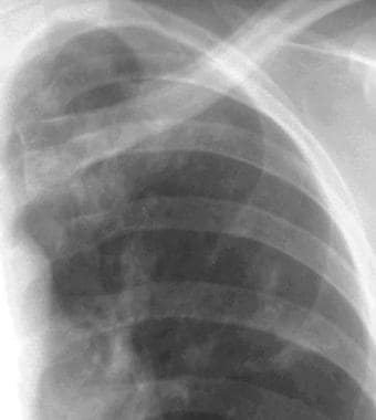 A close-up radiograph of the left upper lung in a 