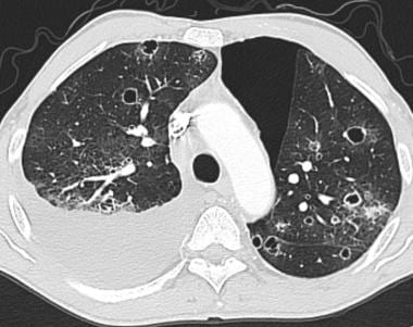 Axial CT scan in a patient with history of angiosa