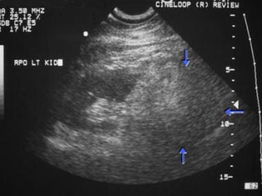 Lymphangioleiomyomatosis. Sagittal view of left ki