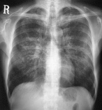 This chest radiograph shows residual interstitial 