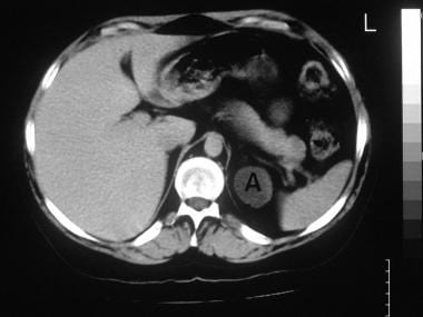 Axial enhanced CT scan in a 32-year-old woman who 