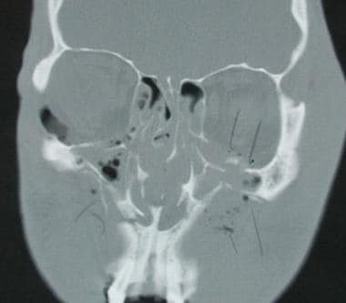 Orbital Fracture Imaging: Practice Essentials, Radiography, Computed ...