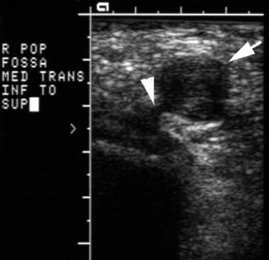 Transverse ultrasonographic image of the knee in a