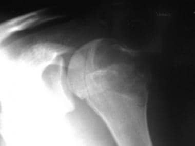 Plain radiograph of the proximal humerus in a 17-y