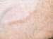 Giant Cell Arteritis (Temporal Arteritis)