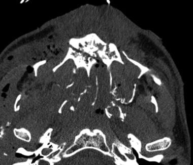 Axial picture. Note bilateral pterygoid plate frac