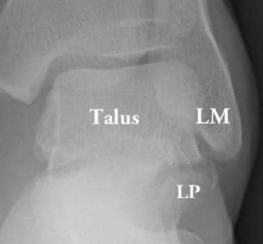 Lateral process fracture, anteroposterior radiogra
