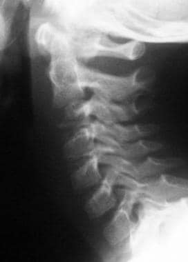 Cervical spine alignment, Radiology Reference Article