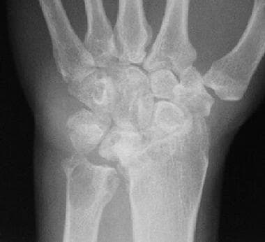 Multiple erosions with deformity of the carpal bon
