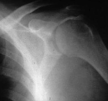 Radiography: Grashey view; Hill-Sachs deformity. 