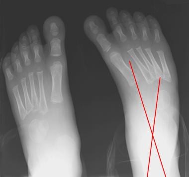 Dorsoplantar views obtained in a patient with unil