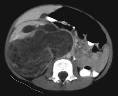 Multilocular cystic nephroma. CT shows a large mul