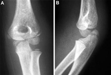 Lateral condyle and olecranon fractures. Anteropos