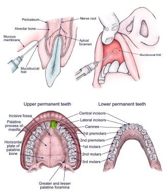 Oral Nerve Block Overview Indications Contraindications - 