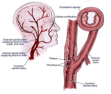 Underlying etiology of carotid artery stenosis is 