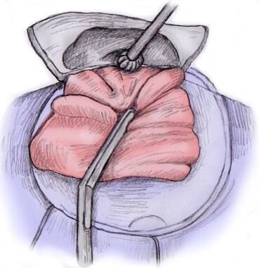 Tympanoplasty Laboratory Medicine