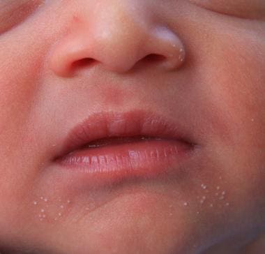 Milia in a week-old infant. 