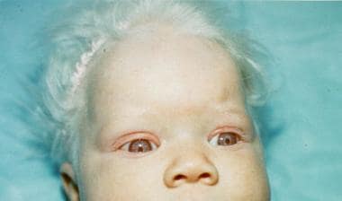 Infant with oculocutaneous albinism type 1 present