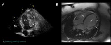 Peripartum cardiomyopathy. These images were obtai