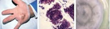 Eumycetoma. Mycetoma of the hand (left). Microscop