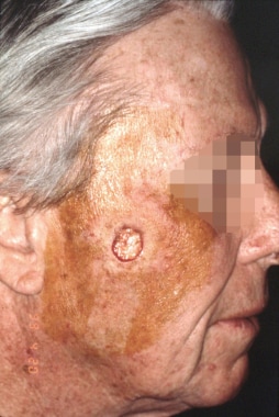 Postoperative Mohs defect on the right cheek of a 