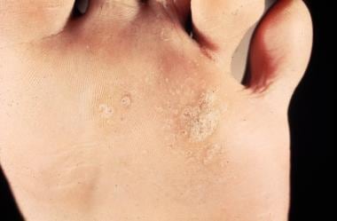 hpv flat warts