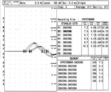 Ulnar Neuropathy Workup: Laboratory Studies, Radiography