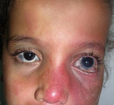 A child with Sturge-Weber syndrome that primarily 