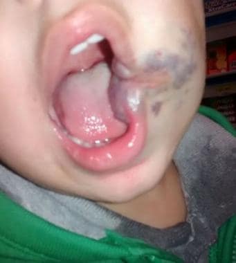 Clinical image of 3-year-old boy who underwent per