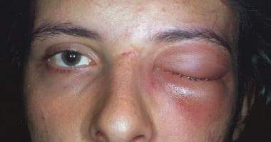 periorbital cellulitis contagious