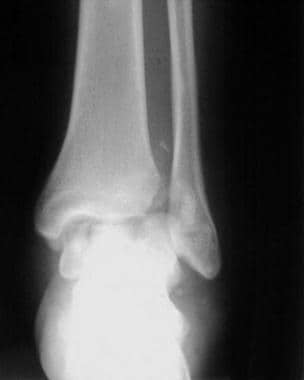 Radiograph showing avulsion fracture of anterolate