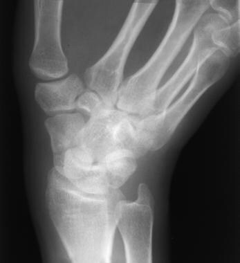 carpal bone fracture