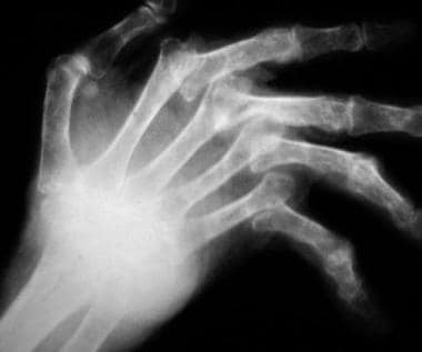 Radiograph of a rheumatoid hand with metacarpophal