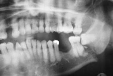 Mandibular fracture. Patient with poorly controlle