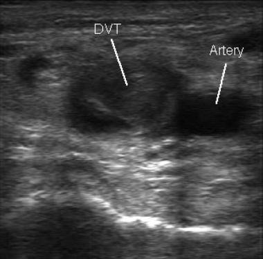 Ultrasonographic image of a deep vein thrombosis (
