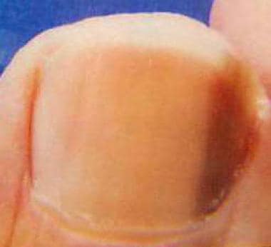 Pigmented longitudinal streak secondary to a nail 